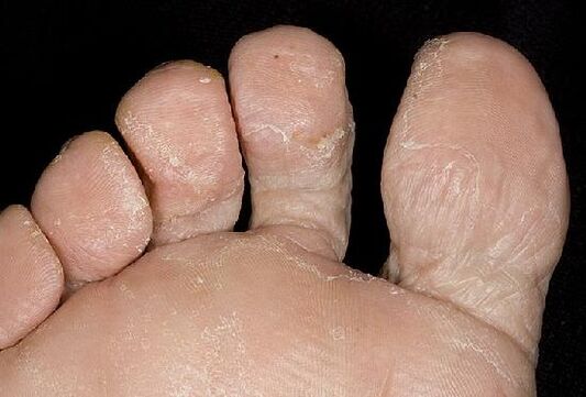 Manifestations of a fungal infection on the feet. 