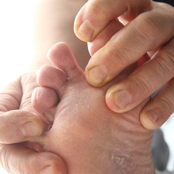 The fungus affects the skin between the toes. 