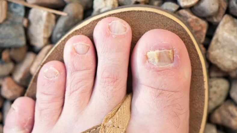 Nail mycosis