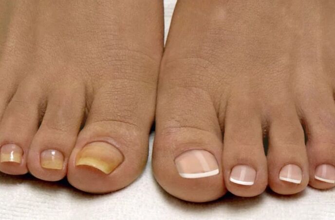 The fungus in the legs