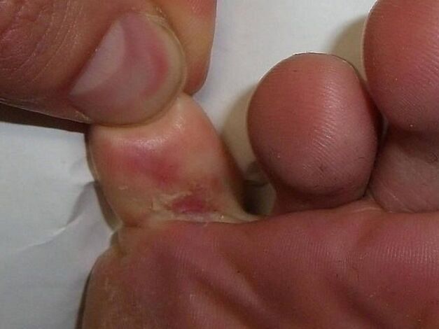 The effect of fungus on the skin