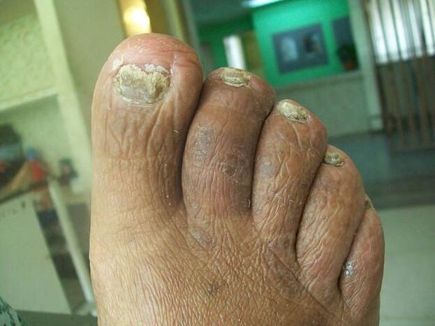 The fungus injury