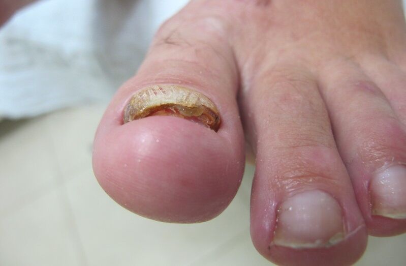 exfoliation of the nail with a common fungus