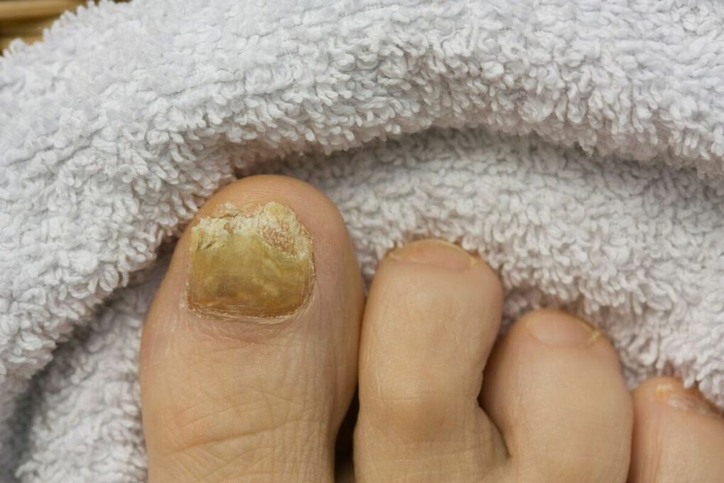 Atrophic stage of the fungus (pieces falling off the toenail)