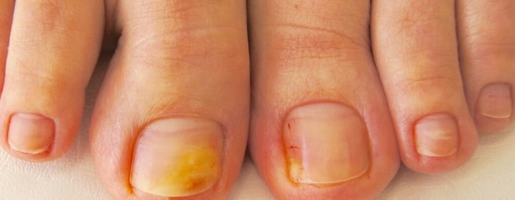 The initial stage of onychomycosis yellowing of the toenails. 
