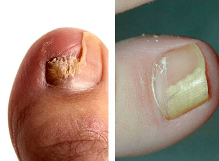 Fungal disease