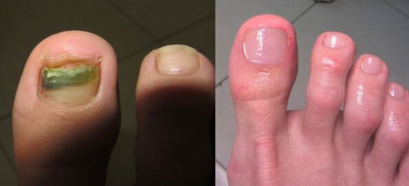 Nail fungus treatment