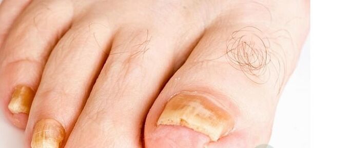 Finger nail fungus varieties