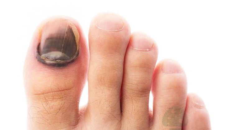 The disease race stage with a thumbnail fungus