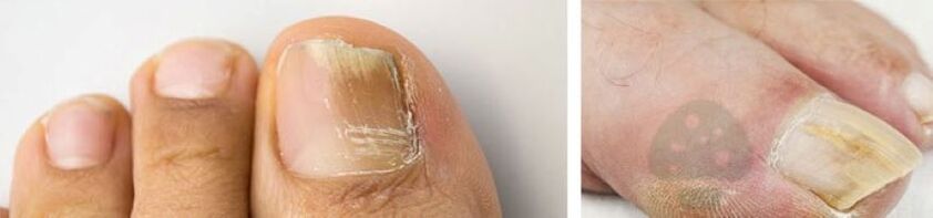 The thumbn nail fungus on the leg