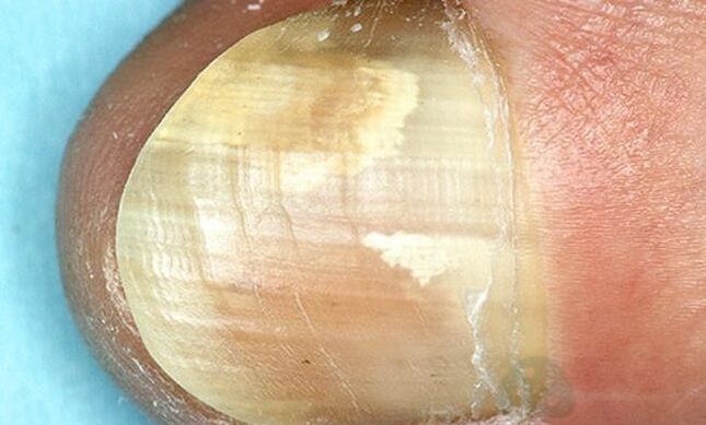 Treatment of fungus of fingers with internal action drugs