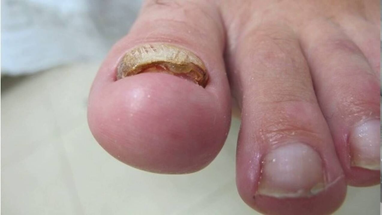 Hypertrophic fungus deformation of the edges, loss of color and thickening of the nail plate. 