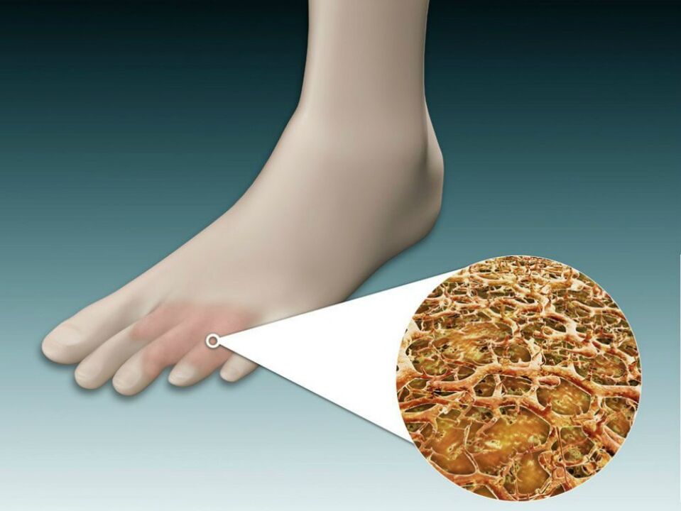 Redness of the skin between and near the toes with intertriginous fungus. 