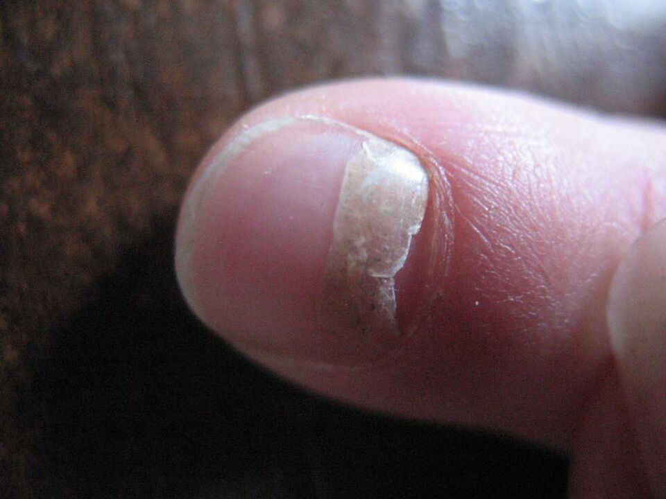 The onycholytic type of fungus is accompanied by detachment of the nail plate. 