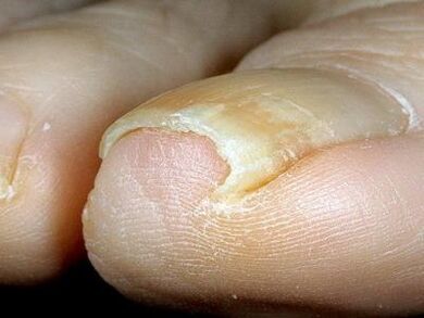 Appearance of toenails infected with fungus. 