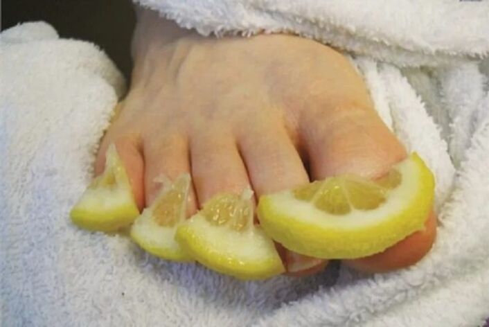 Lemon drop compresses a popular remedy for toenail fungus