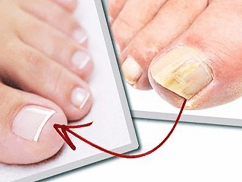 Toenails affected by fungus and healthy nails after home treatment. 